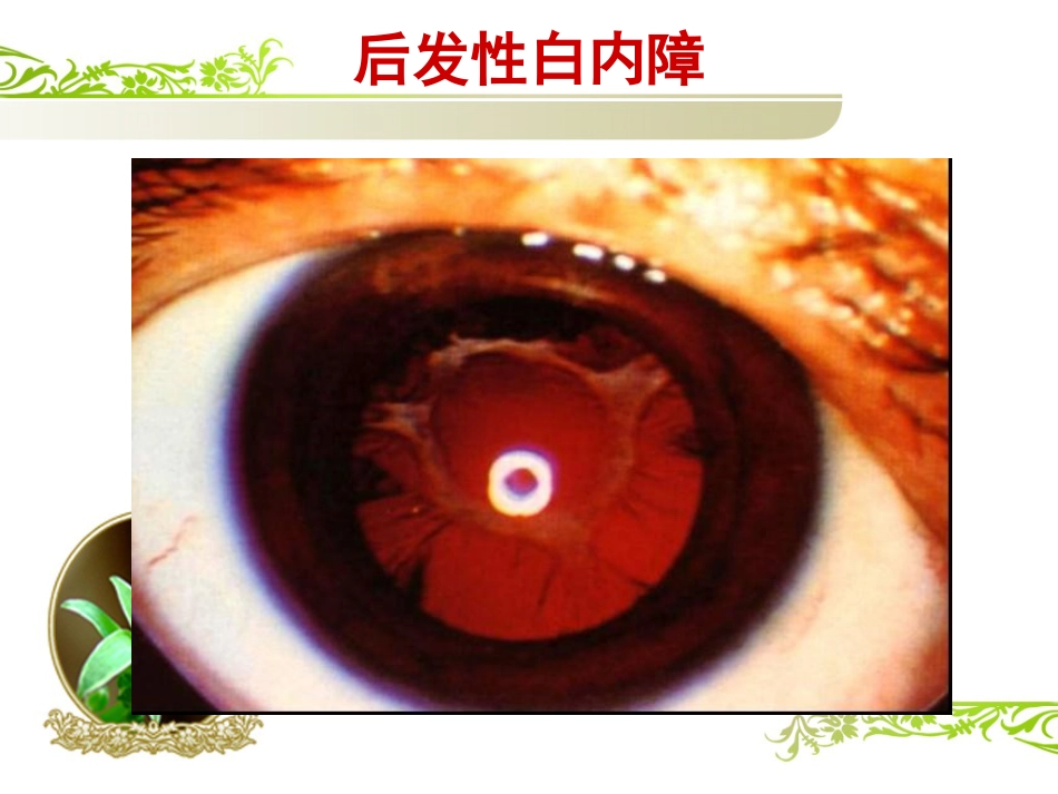 白内障(1)_第10页