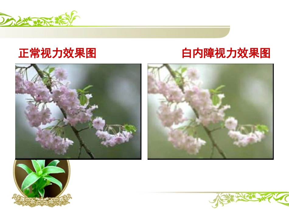 白内障(1)_第12页