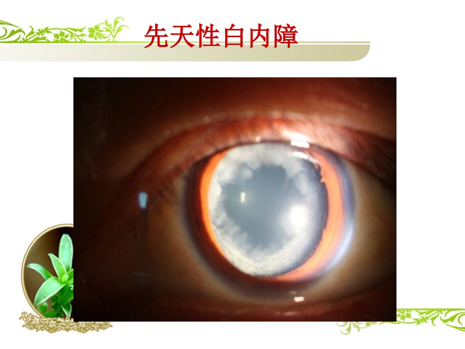 白内障(1)_第6页