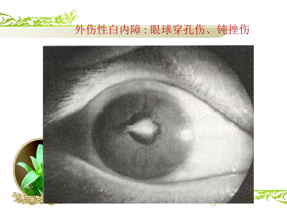 白内障(1)_第7页
