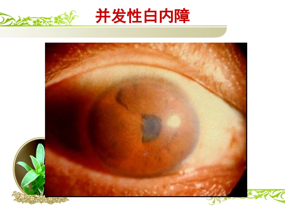 白内障(1)_第8页