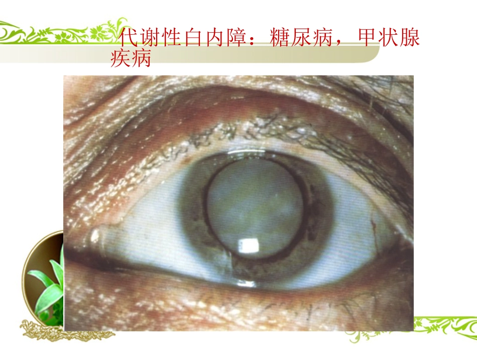 白内障(1)_第9页