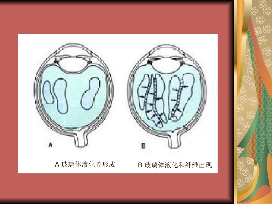 玻璃体疾病(1)_第12页