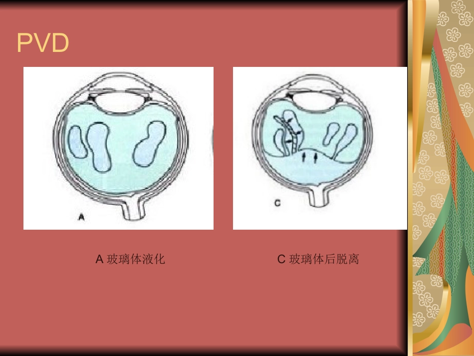 玻璃体疾病(1)_第15页