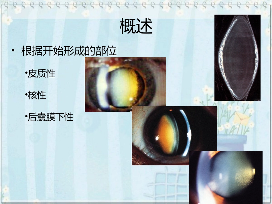 白内障(2)_第11页