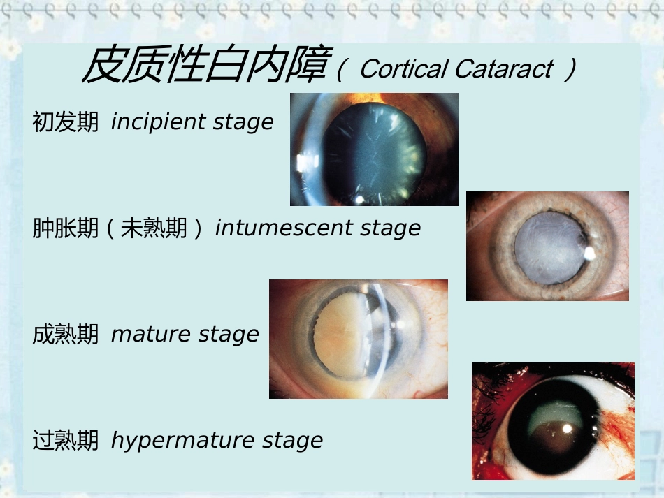 白内障(2)_第12页