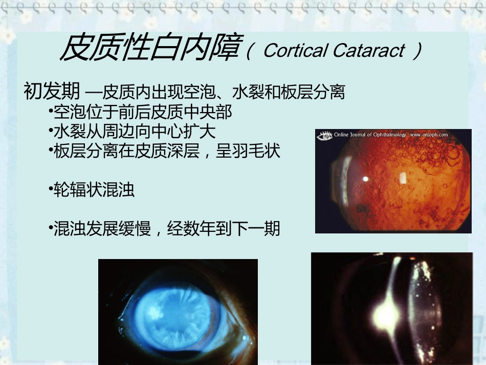 白内障(2)_第13页
