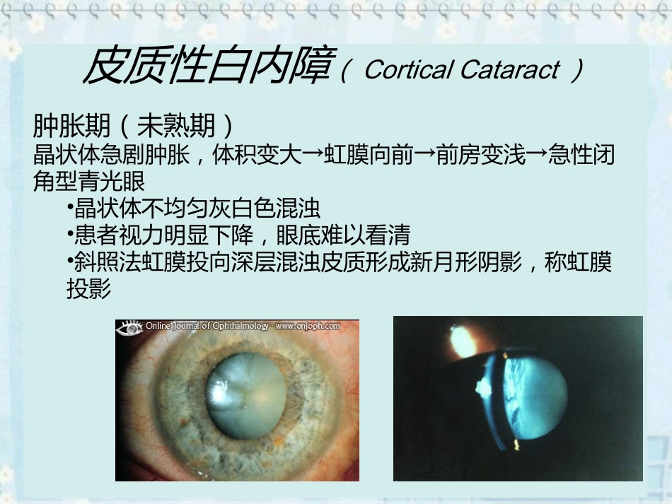 白内障(2)_第14页