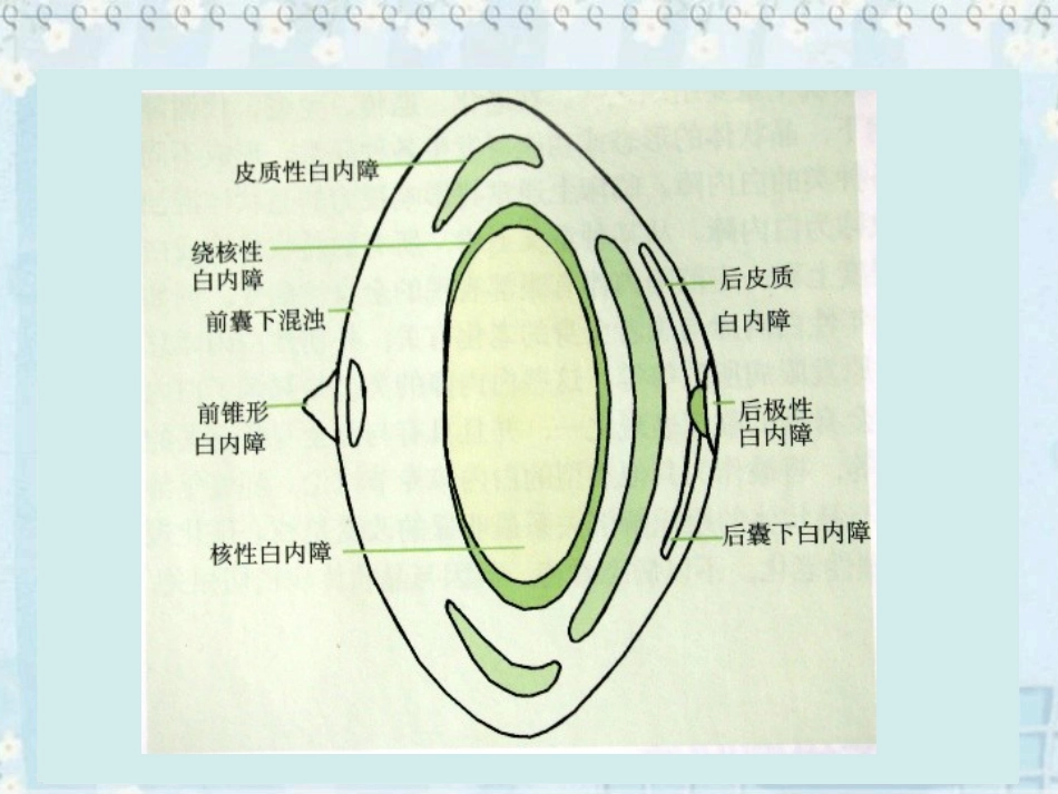 白内障(2)_第6页