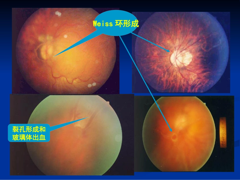 玻璃体病 (2)_第11页