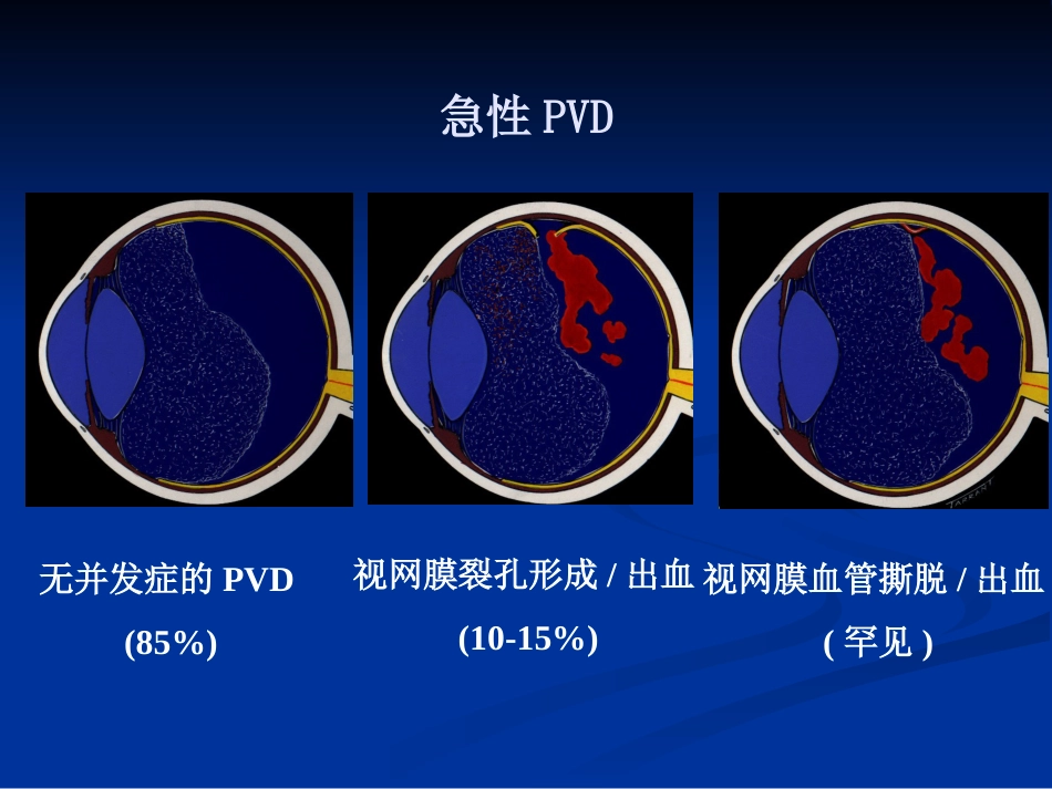 玻璃体病 (2)_第12页