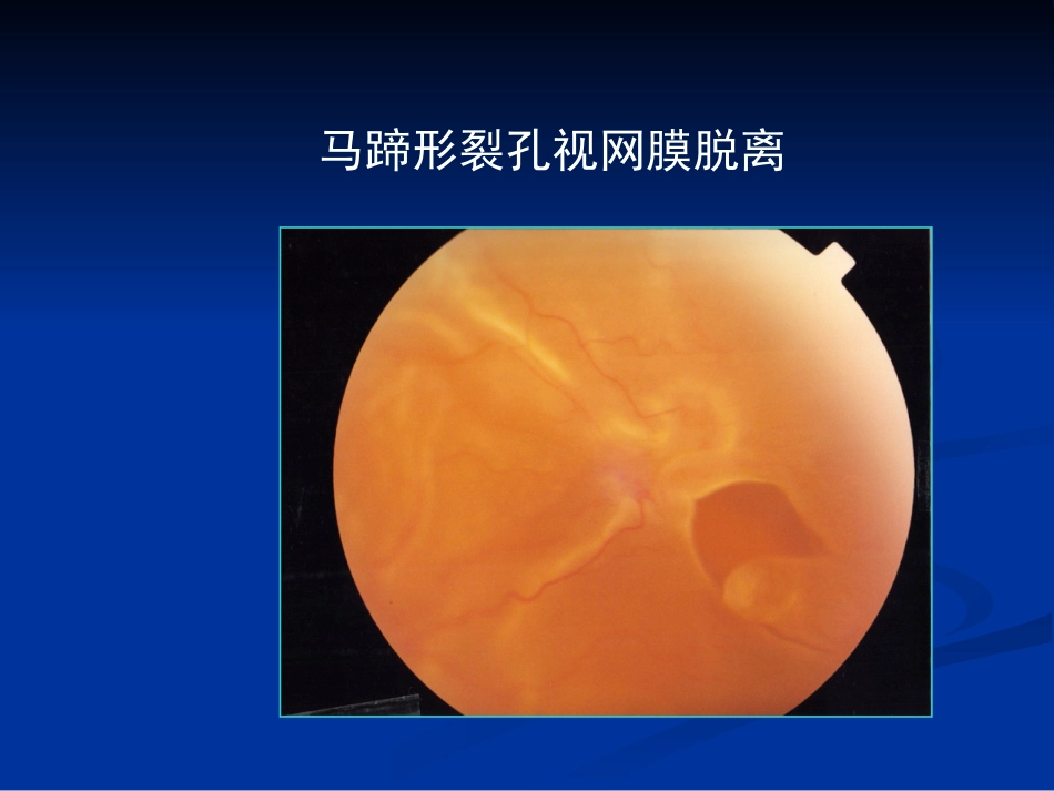 玻璃体病 (2)_第14页