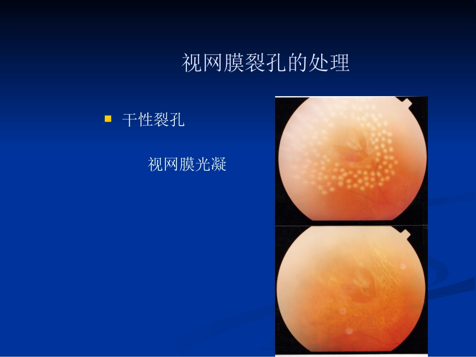 玻璃体病 (2)_第15页