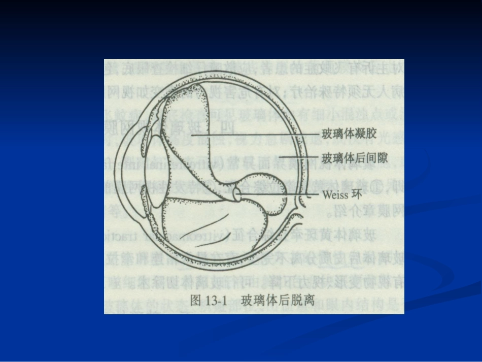 玻璃体病 (2)_第9页