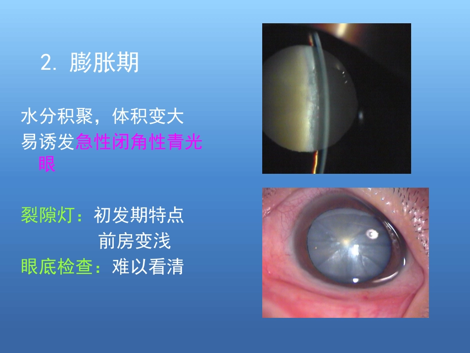 白内障的诊断与治疗(2)_第11页