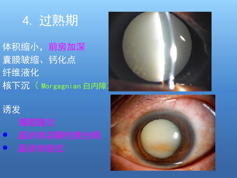 白内障的诊断与治疗(2)_第13页