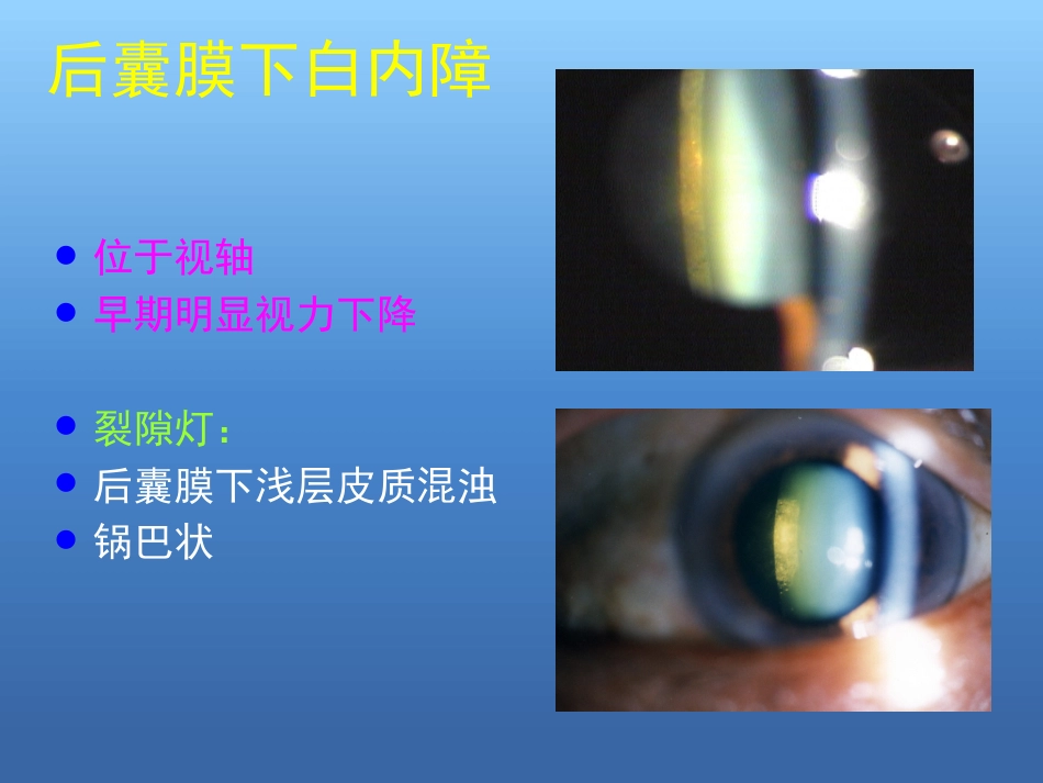 白内障的诊断与治疗(2)_第15页