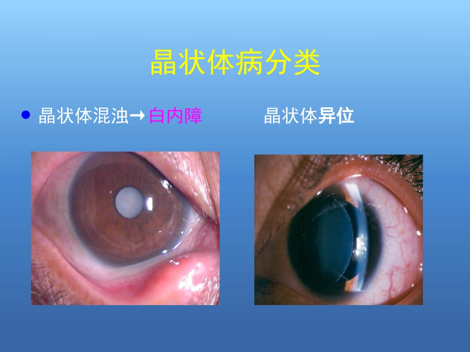 白内障的诊断与治疗(2)_第3页