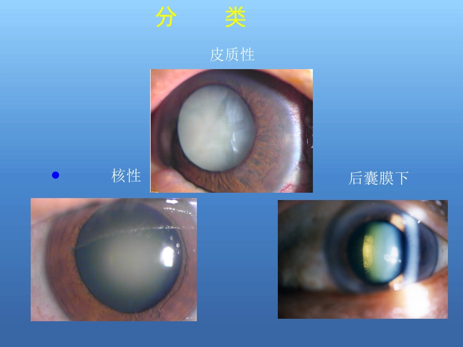 白内障的诊断与治疗(2)_第7页