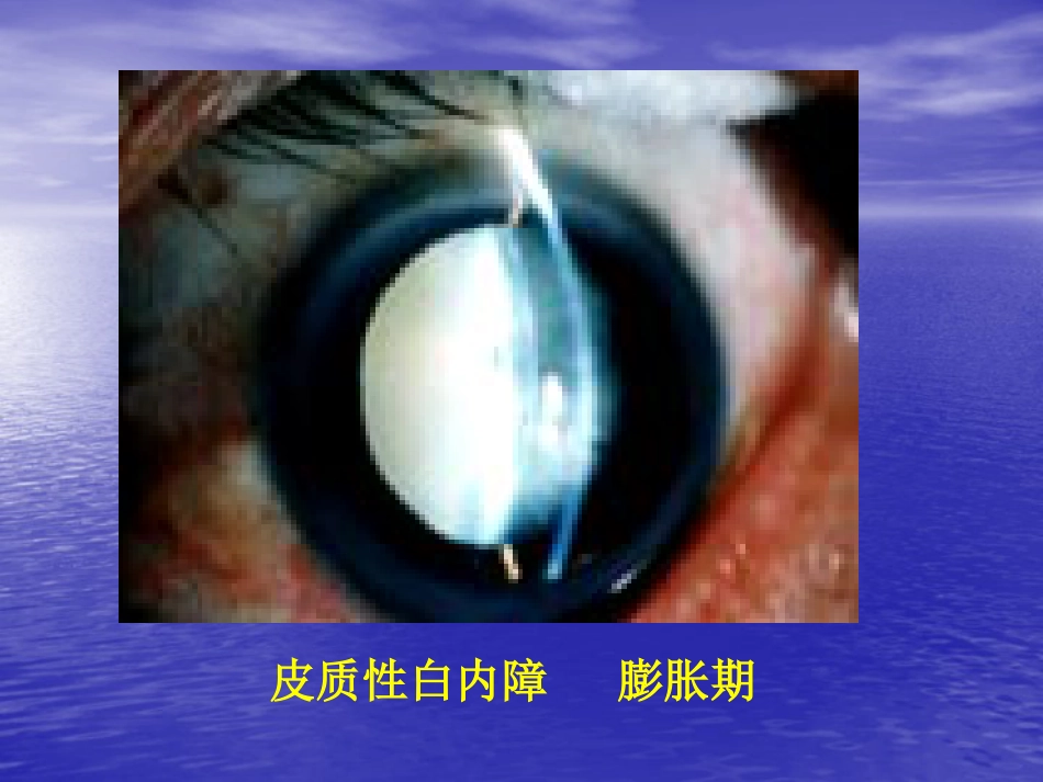 白内障(3)_第14页