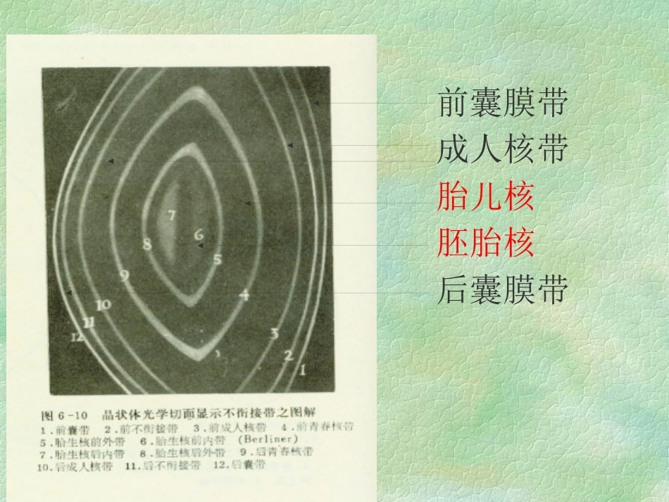 白内障(4)_第4页
