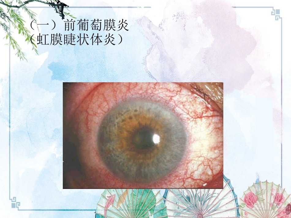 【眼病学】10葡萄膜病_第15页