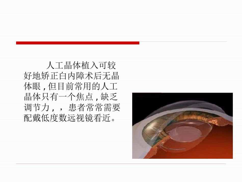 92217-白内障-多焦人工晶体_第2页