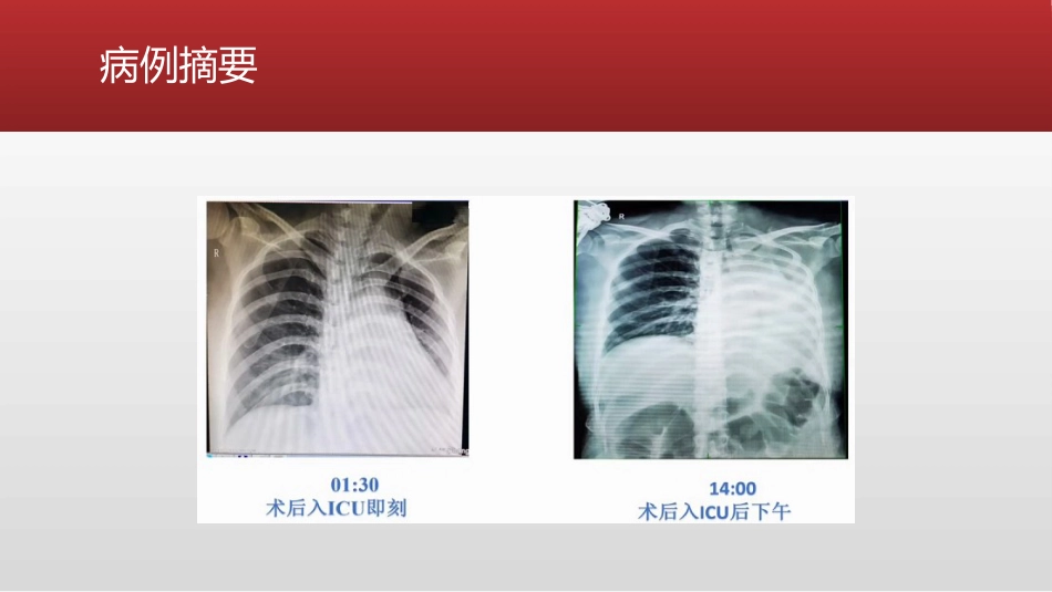 HELLP综合症产妇的麻醉及术后管理_第14页