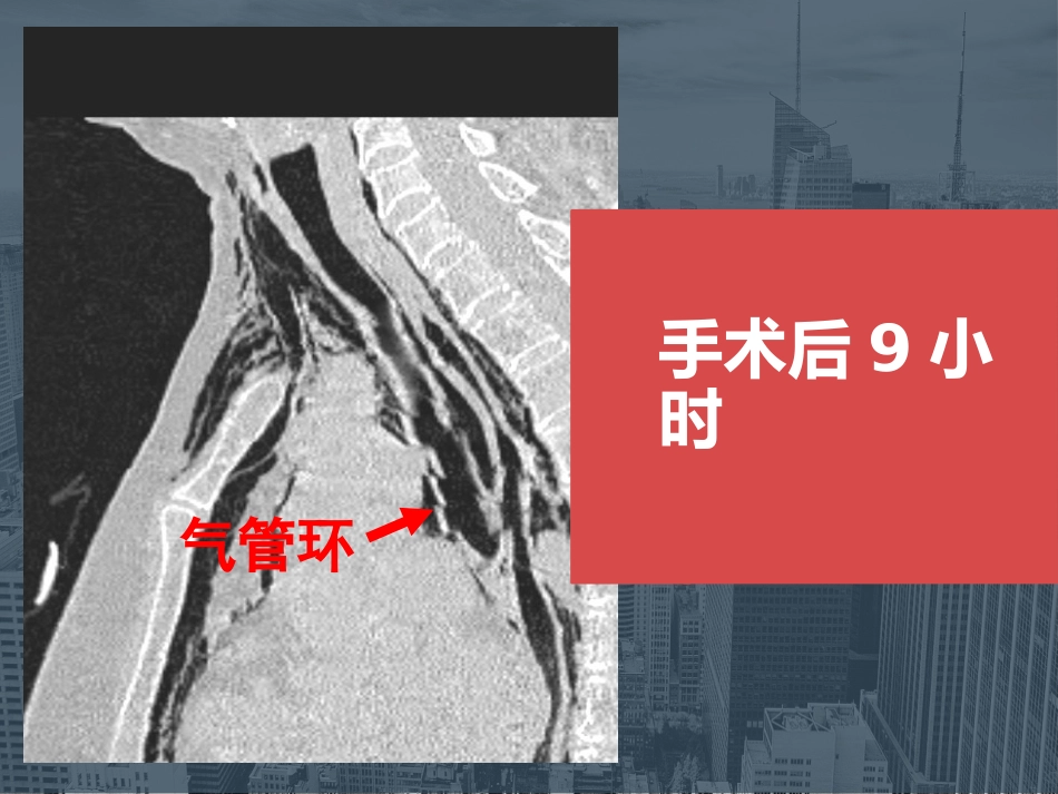 【麻醉技能学习】鼻内镜下鼻腔占位切除术的术后镇痛_第10页