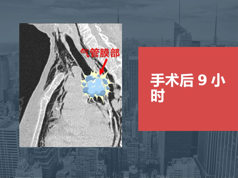 【麻醉技能学习】鼻内镜下鼻腔占位切除术的术后镇痛_第11页