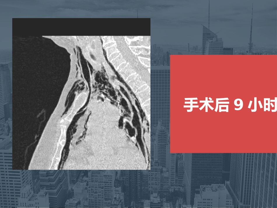 【麻醉技能学习】鼻内镜下鼻腔占位切除术的术后镇痛_第12页