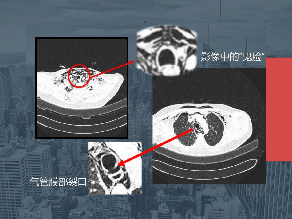 【麻醉技能学习】鼻内镜下鼻腔占位切除术的术后镇痛_第13页
