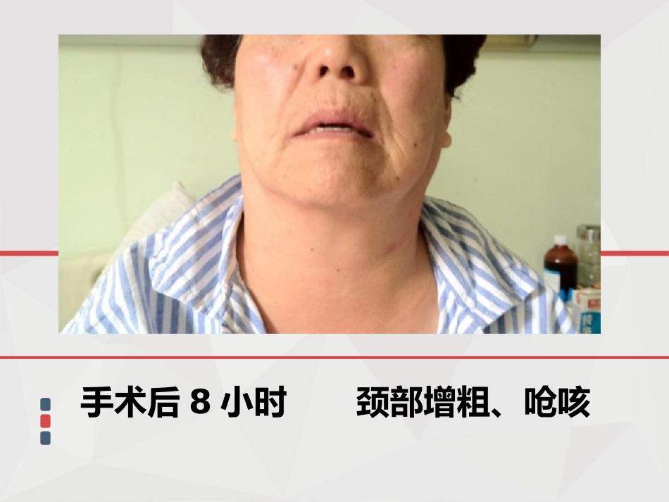 【麻醉技能学习】鼻内镜下鼻腔占位切除术的术后镇痛_第5页