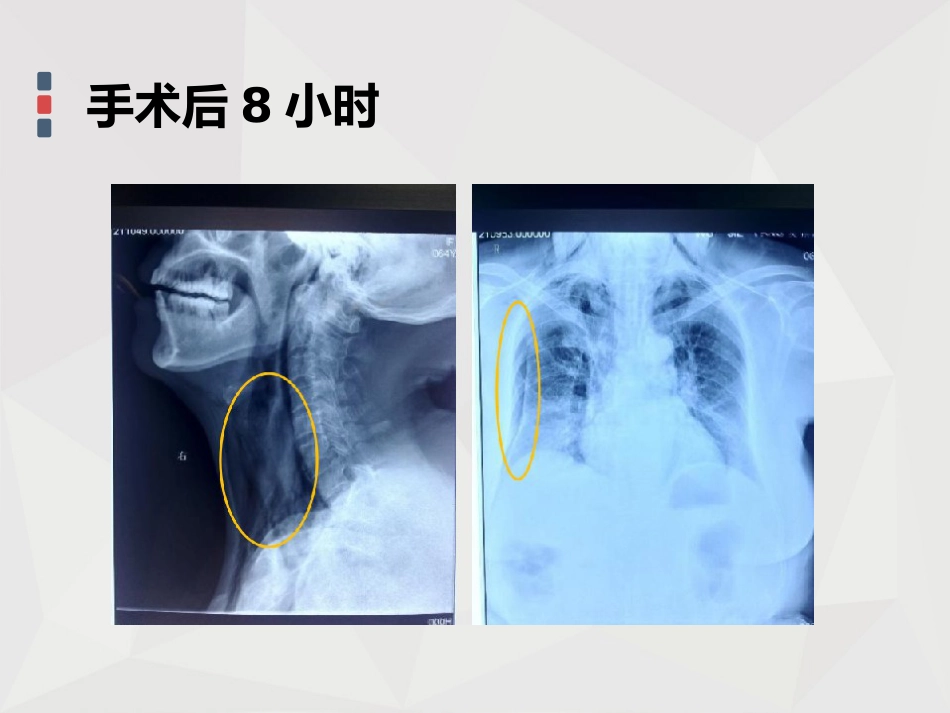 【麻醉技能学习】鼻内镜下鼻腔占位切除术的术后镇痛_第6页