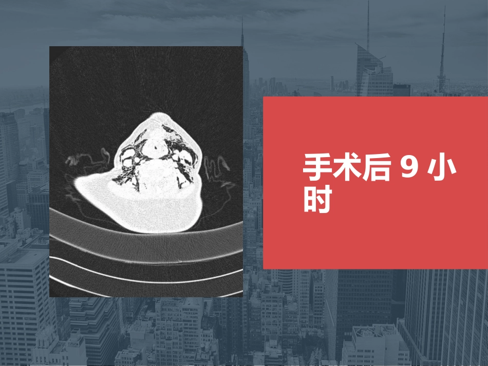 【麻醉技能学习】鼻内镜下鼻腔占位切除术的术后镇痛_第8页