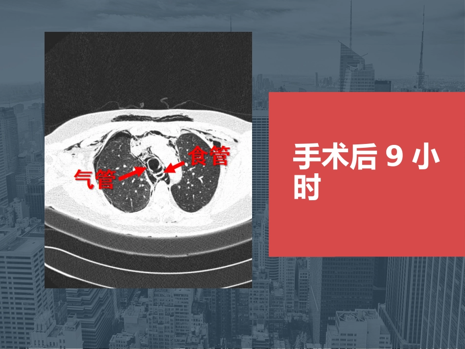 【麻醉技能学习】鼻内镜下鼻腔占位切除术的术后镇痛_第9页