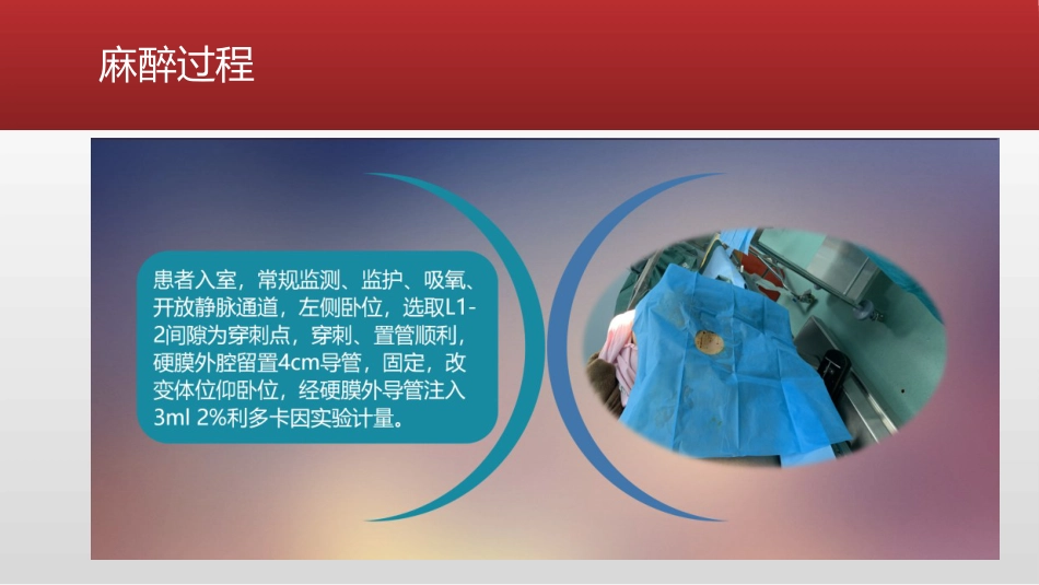 艾司氯胺酮产科麻醉分析_第4页
