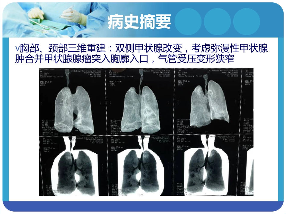 《巨大甲状腺肿麻醉》PPT课件_第5页