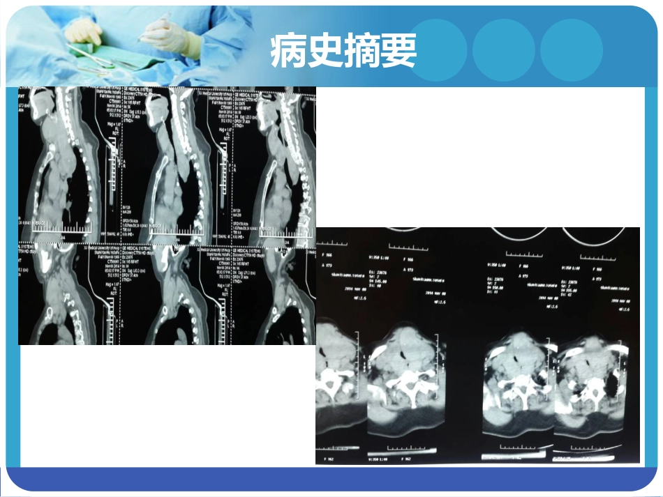 《巨大甲状腺肿麻醉》PPT课件_第6页