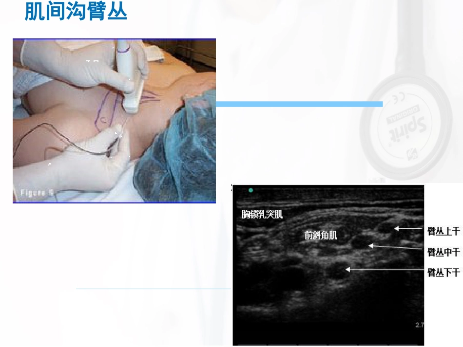 臂丛神经阻滞麻醉_第13页