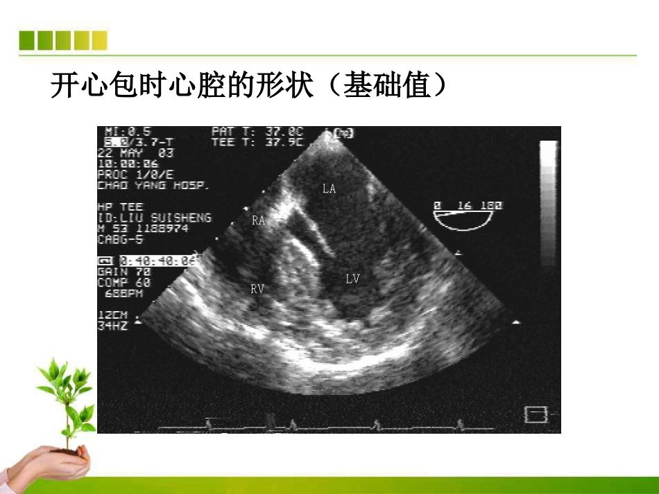 不停跳冠脉搭桥手术血流动力学监测及麻醉管理ppt课件_第11页