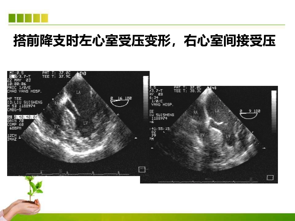 不停跳冠脉搭桥手术血流动力学监测及麻醉管理ppt课件_第12页