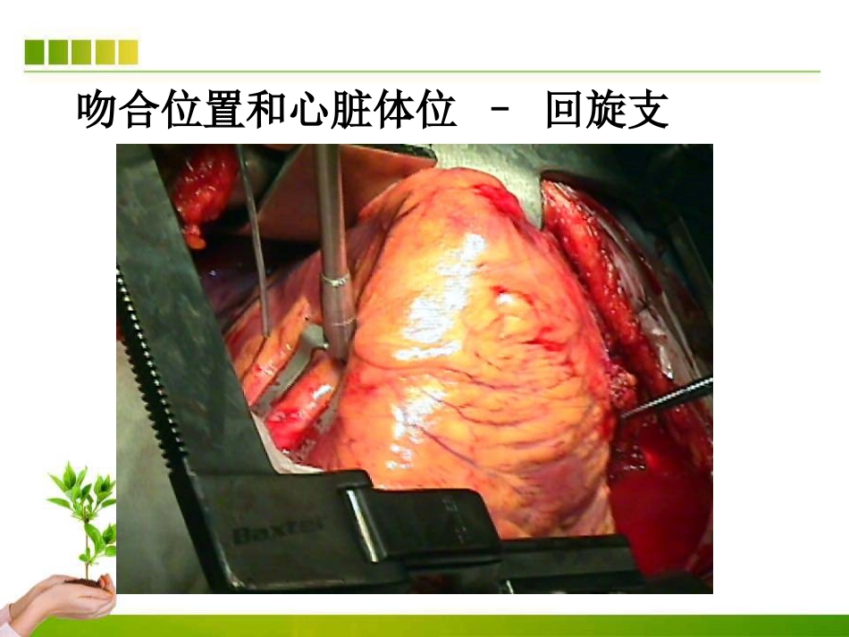 不停跳冠脉搭桥手术血流动力学监测及麻醉管理ppt课件_第13页