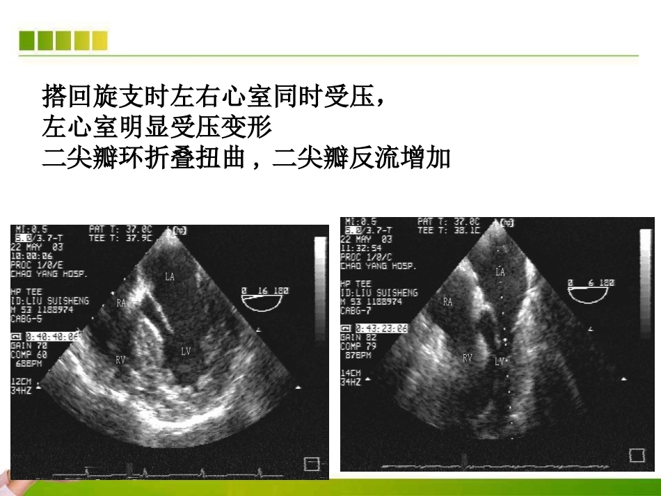 不停跳冠脉搭桥手术血流动力学监测及麻醉管理ppt课件_第14页