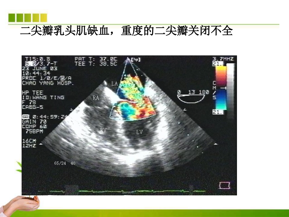不停跳冠脉搭桥手术血流动力学监测及麻醉管理ppt课件_第15页