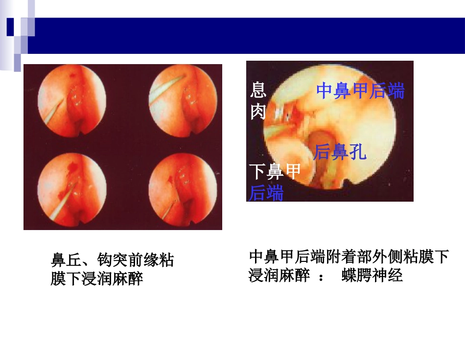 鼻、鼻窦和头颈部肿瘤的麻醉处理PPT_第12页