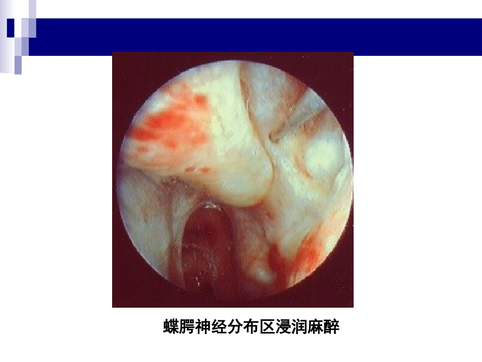 鼻、鼻窦和头颈部肿瘤的麻醉处理PPT_第13页