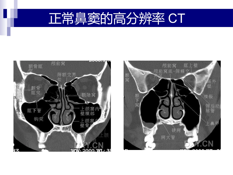鼻、鼻窦和头颈部肿瘤的麻醉处理PPT_第4页