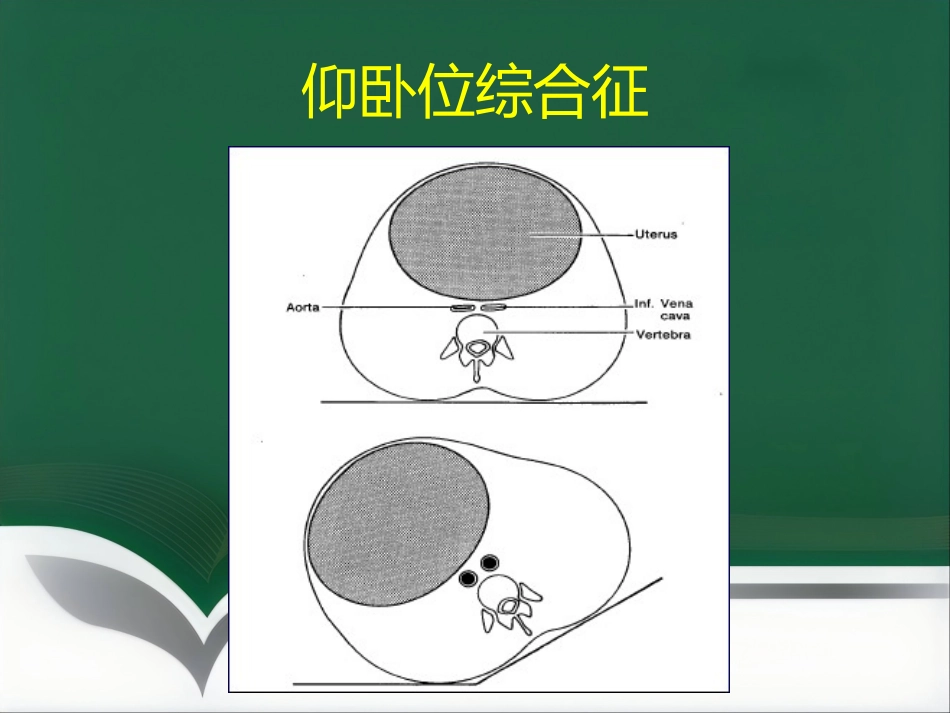 产科手术的麻醉_第8页