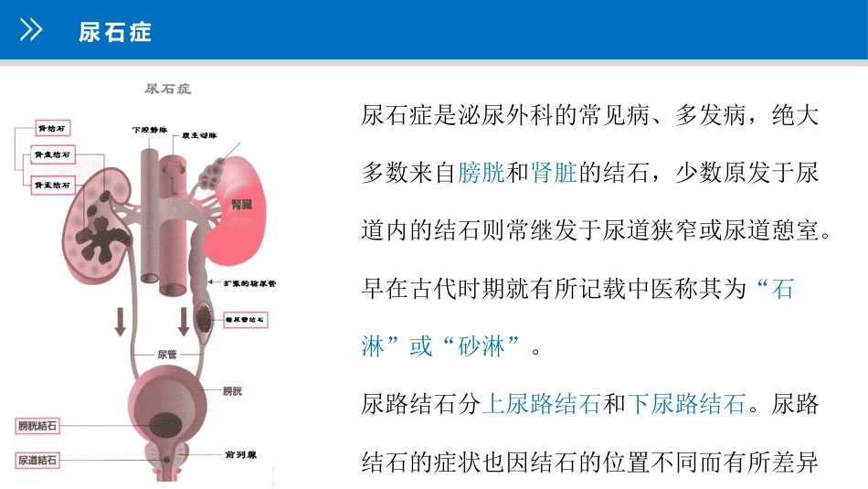 上尿路结石护理疑难病例讨论_第8页
